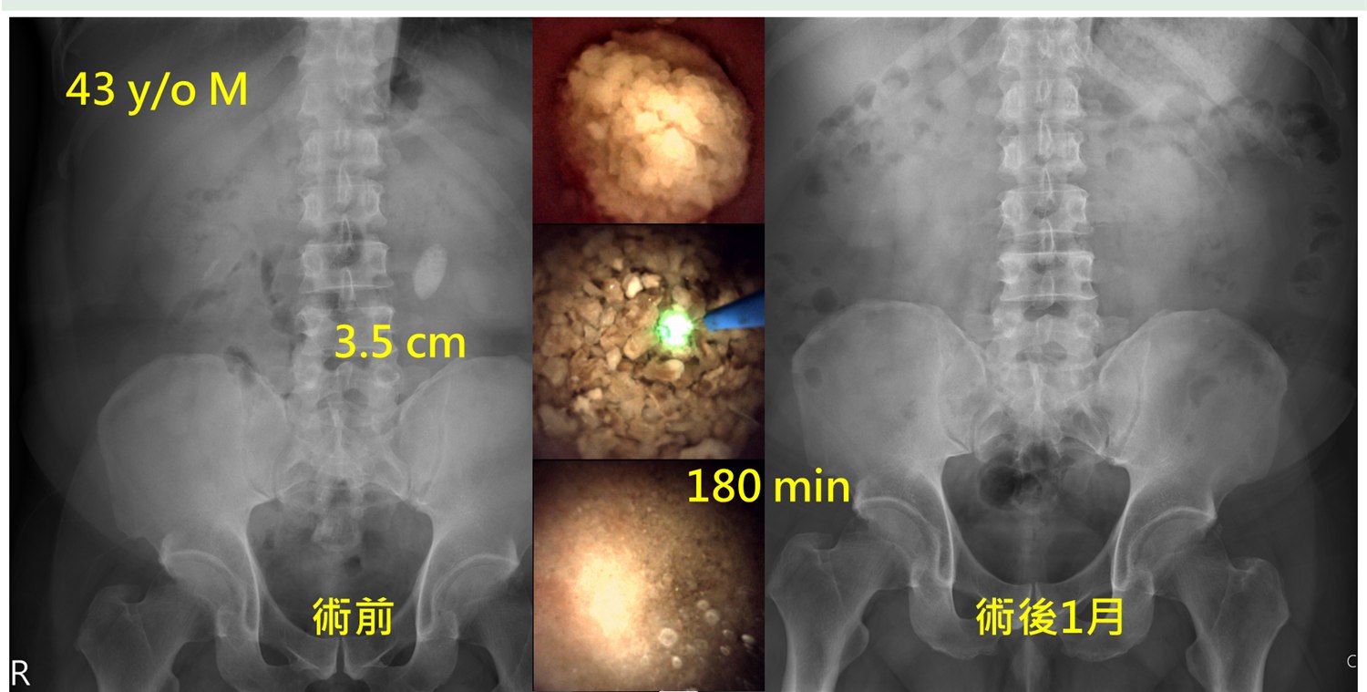 兩張腹部 X 光併排，左側術前可見上段輸尿管有一顆三點五公分的大結石，中間三張內視鏡畫面顯示雷射正在擊碎結石，右側術後一個月的 X 光已看不到結石，圖上標註手術時間一百八十分鐘