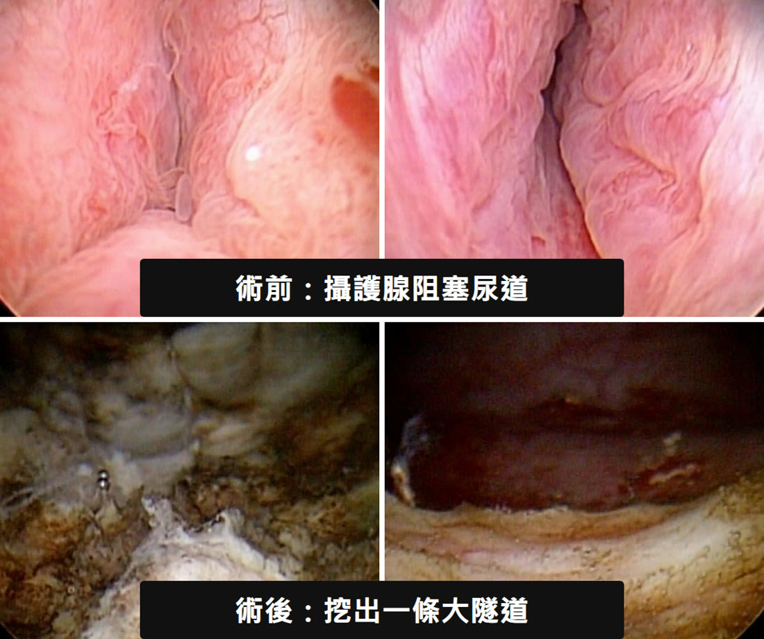 四格膀胱鏡畫面。上面兩格標示「術前，攝護腺阻塞尿道」，粉紅色的攝護腺組織從兩側往中間擠，只剩一道窄縫；下面兩格標示「術後，挖出一條大隧道」，原本擠在一起的組織被清掉，變成一條寬敞的通道