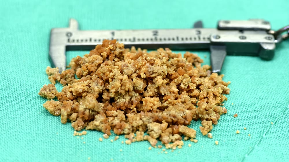 綠色手術鋪單上一大堆橘褐色的碎石塊，大小從砂粒到幾公釐都有，後面放著一把金屬卡尺