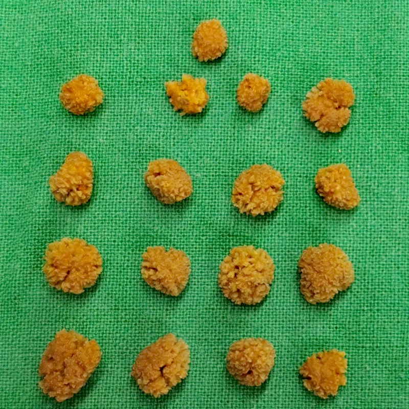 綠色手術鋪單上排得整整齊齊的十幾顆橘色結石，每顆大約半公分上下，表面凹凸不平