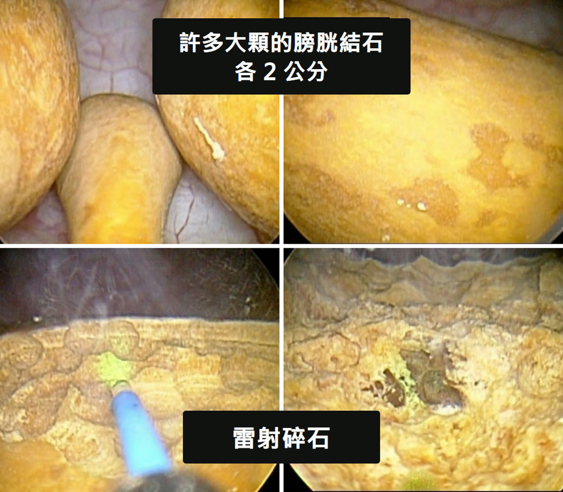 四格膀胱鏡畫面。上面兩格是膀胱裡好幾顆土黃色、橢圓形的大結石擠在一起，標示「許多大顆的膀胱結石，各 2 公分」；下面兩格是藍色的雷射光纖對著結石表面，打到的地方發出綠光，結石表面被打出一個洞，標示「雷射碎石」
