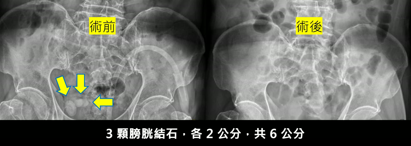 左右兩張骨盆 X 光片。左邊標示「術前」，骨盆中央下方有三顆圓形的白色結石，用三個黃色箭頭標出；右邊標示「術後」，同一個位置已經看不到結石。下方寫著「3 顆膀胱結石，各 2 公分，共 6 公分」
