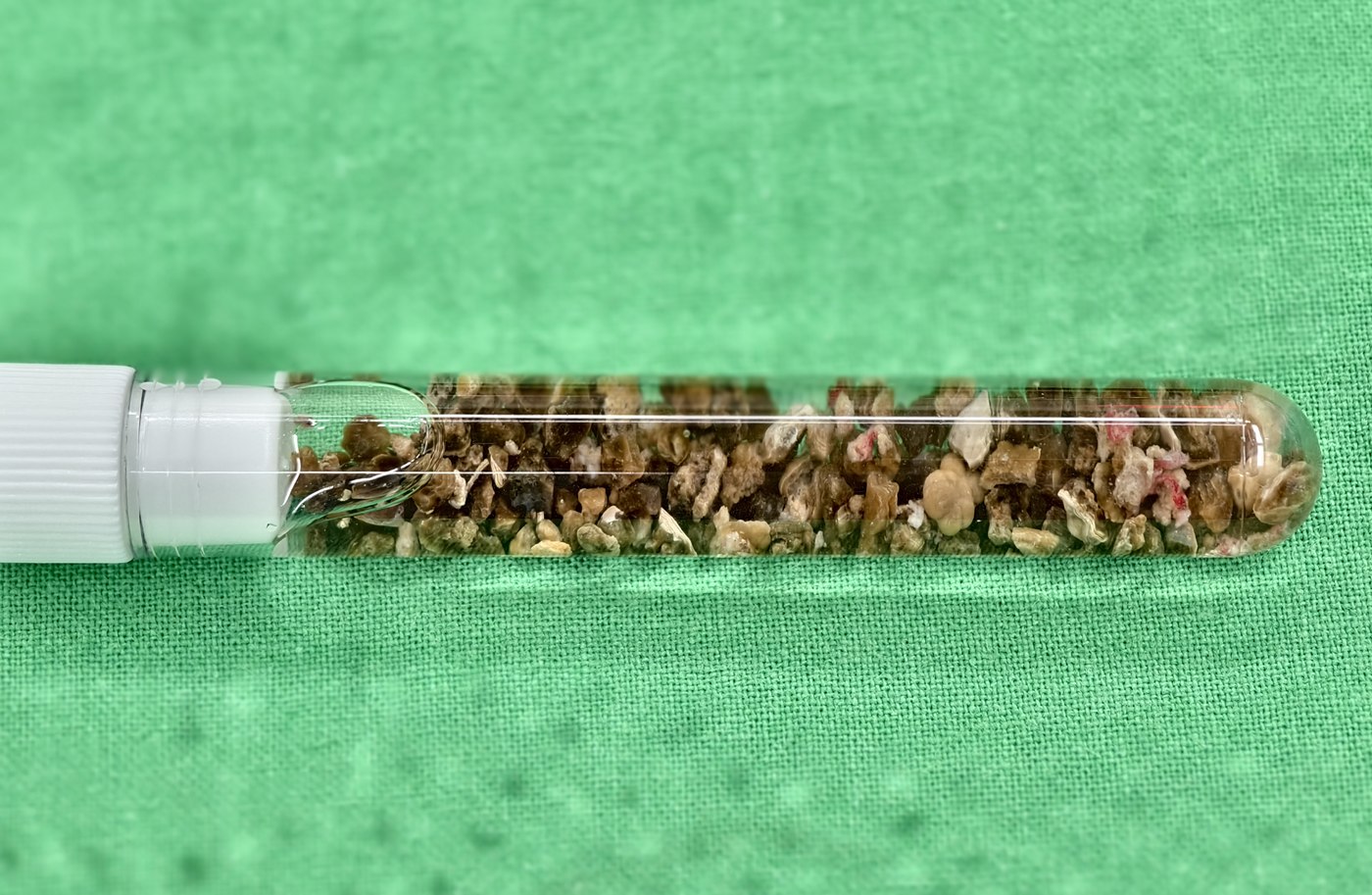 綠色手術鋪單上橫放的檢體試管，管內從頭到尾塞滿褐色與土黃色的結石碎粒