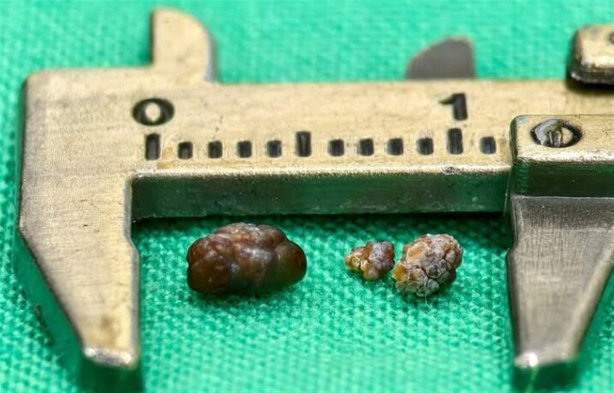 綠色手術鋪單上，游標卡尺的量爪之間放著三顆結石，最大的一顆約半公分、呈深褐色，另外兩顆更小、顏色較淺