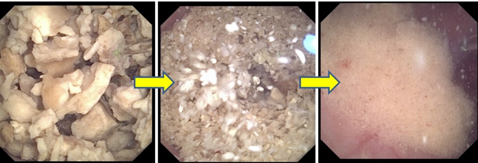 三張手術中的內視鏡畫面以箭頭串連：左邊是腎盞裡一堆指甲大小的淡黃色碎塊，中間碎塊已被打得更細、像粗沙一樣鋪滿視野，右邊只剩一片細白的粉末覆蓋在腎臟黏膜上
