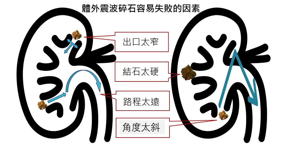 腎臟剖面示意圖，標示體外震波碎石容易失敗的四個因素：出口太窄、結石太硬、路程太遠、角度太斜