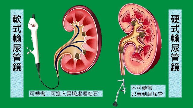 軟式與硬式輸尿管鏡的對照圖：軟式可轉彎、能進入腎臟處理結石；硬式不可轉彎，只能到達輸尿管