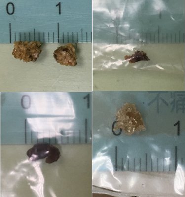 四張腎結石檢體照片，每顆都放在標有刻度的尺旁對照，可看出結石實際只有零點幾公分大