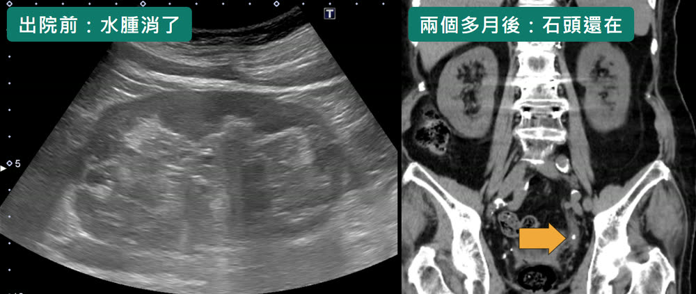 兩張影像並排，左上角各有墨綠色標籤。左邊「出院前：水腫消了」是扇形的腎臟超音波，橢圓形的腎臟中間看不到撐開的黑色積水；右邊「兩個多月後：石頭還在」是腹部電腦斷層冠狀切面，琥珀色箭頭指著骨盆腔左側、輸尿管下段的一個小白點