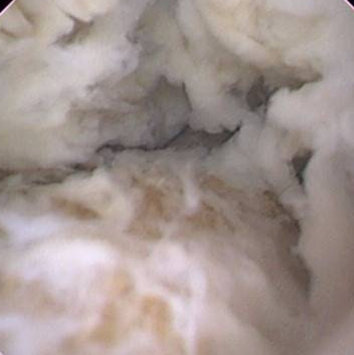 內視鏡畫面：腎臟內大片白色棉絮狀的感染沉積物，質地鬆軟蓬鬆，幾乎填滿整個視野，底下隱約可見淡黃色的結石表面