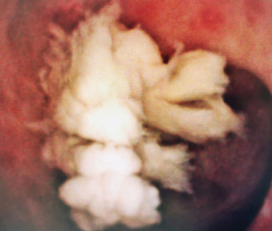 內視鏡畫面：腎臟裡一大團乳白色、蓬鬆像棉花又像麻糬的軟結石，周圍是發紅的腎臟黏膜