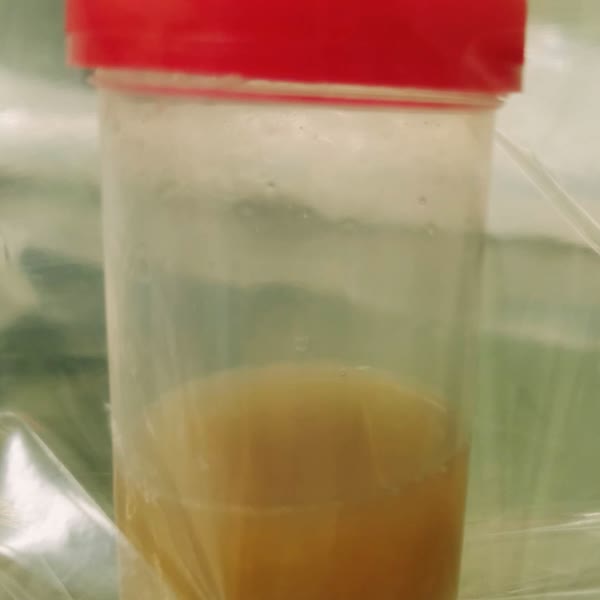 紅色蓋子的透明檢體杯，下半部裝著混濁的黃褐色液體