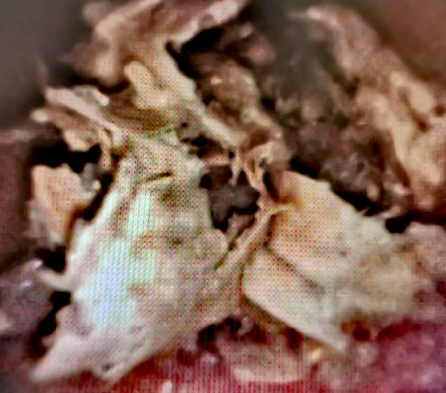 內視鏡畫面：腎臟裡的感染性結石碎片，呈米白到褐色，一片一片鬆散地疊在一起，邊緣毛毛的，看起來濕軟