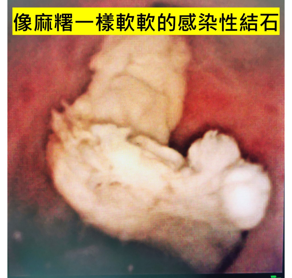 內視鏡畫面：腎臟內一顆乳白色、表面不規則的感染性結石，質地看起來柔軟，圖上標示「像麻糬一樣軟軟的感染性結石」
