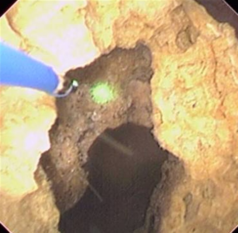 內視鏡下的雷射碎石畫面：一根藍色的雷射光纖從左上方伸入，頂端發出綠色的光點，光點旁邊的黃色結石上已經被打出一個深色的凹洞