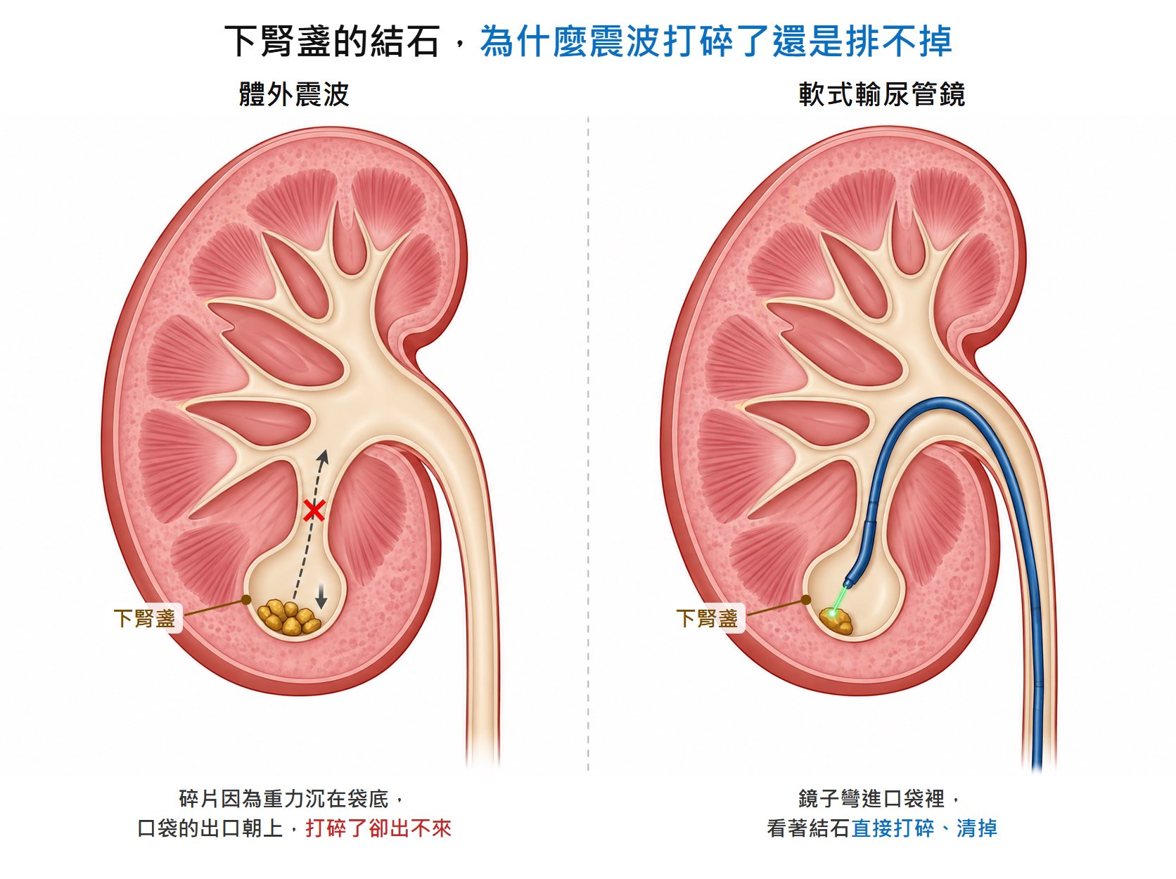 兩格腎臟剖面示意圖，標題「下腎盞的結石，為什麼震波打碎了還是排不掉」。左格「體外震波」：腎臟下方的下腎盞像一個袋底朝下、頸部較窄的口袋，袋底沉著一堆黃褐色碎石，一個向下的箭頭表示重力，一條往上指向腎盂的虛線箭頭打著紅叉，說明碎片沉在袋底、打碎了卻出不來。右格「軟式輸尿管鏡」：一支藍色軟鏡沿輸尿管上到腎盂，前端往下彎進下腎盞，對著袋底的結石發出綠色雷射光，說明鏡子彎進口袋裡直接打碎、清掉