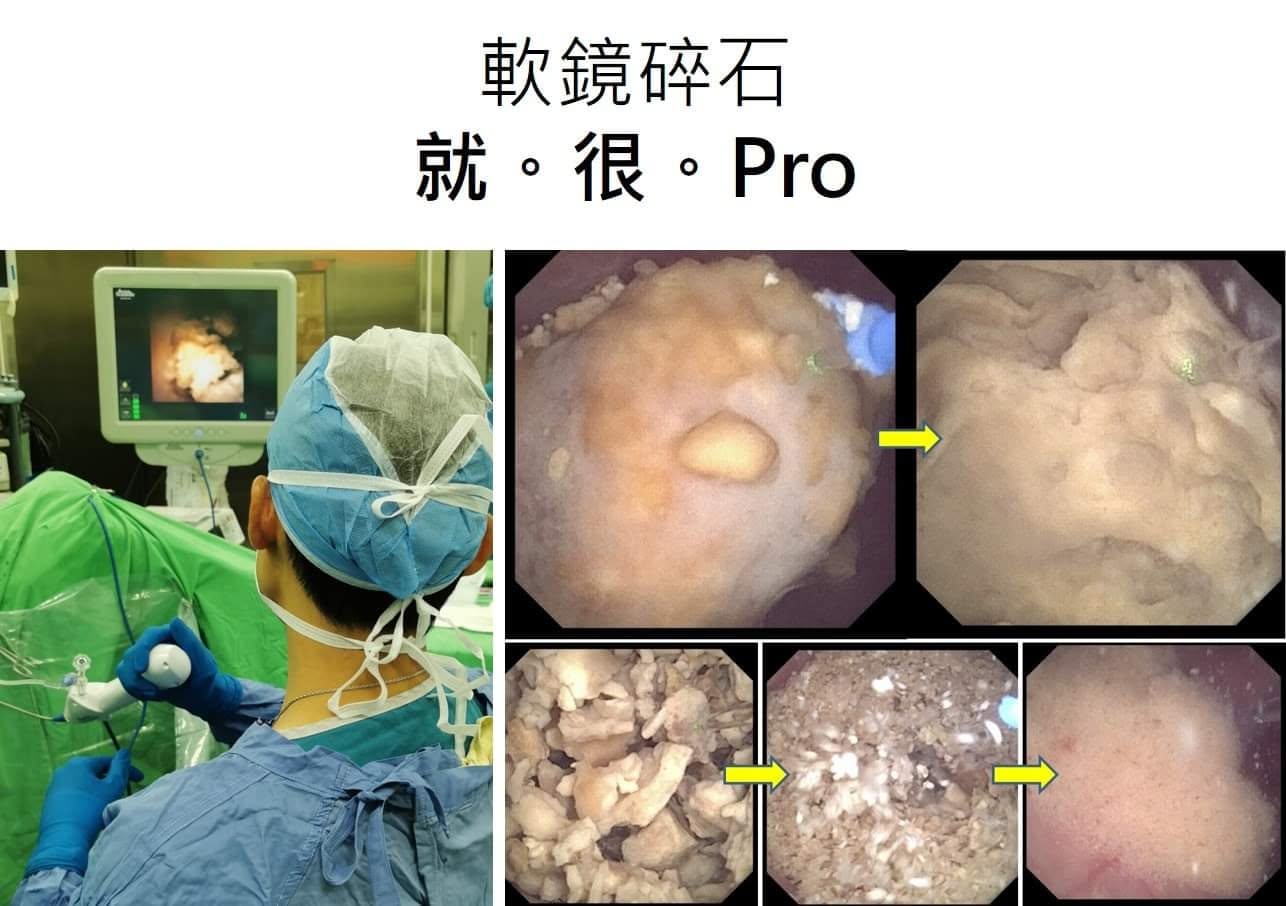 梗圖：上方大字「軟鏡碎石　就。很。Pro」。左邊是穿藍色手術衣、戴手術帽的醫師背影，手握軟式輸尿管鏡，看著前方螢幕；右邊五格內視鏡畫面，用黃色箭頭串起來：一大顆完整的結石被雷射打成碎塊、再打成像沙子一樣的細屑，最後一格只剩乾淨的粉紅色腎臟內壁
