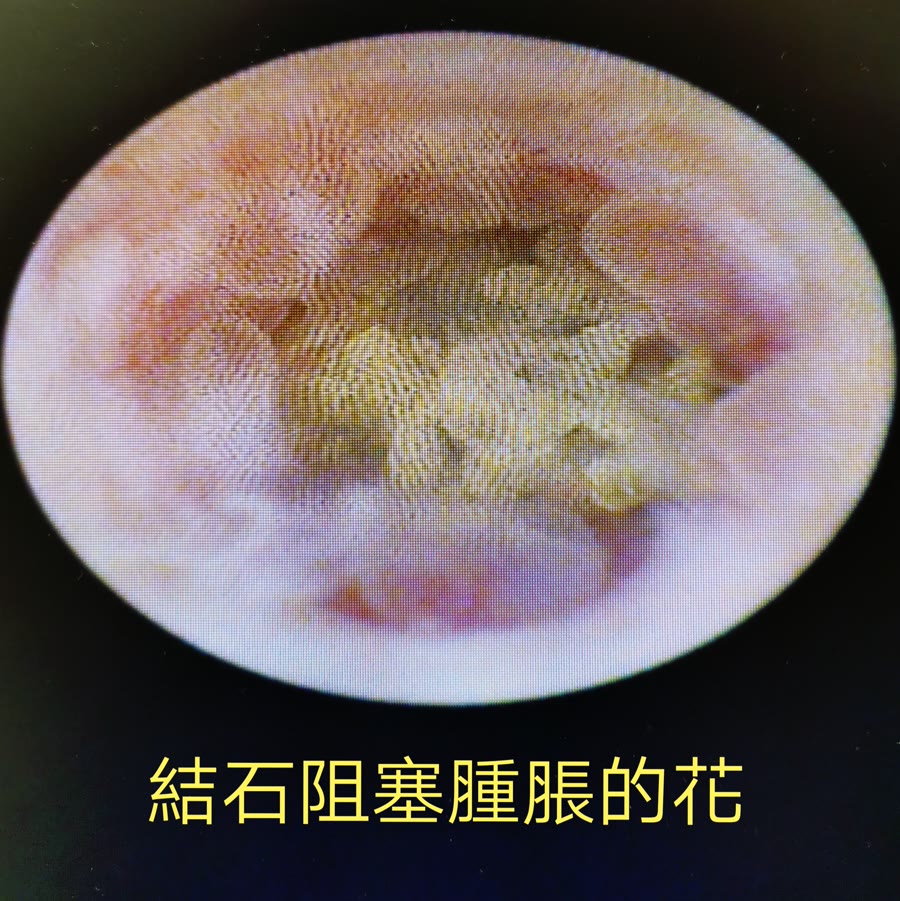 圓形的輸尿管鏡畫面，從螢幕翻拍：中間是一團黃色、顆粒狀的結石，四周圍著一圈腫起來的粉紅色輸尿管壁，像花瓣一樣，下方寫著「結石阻塞腫脹的花」