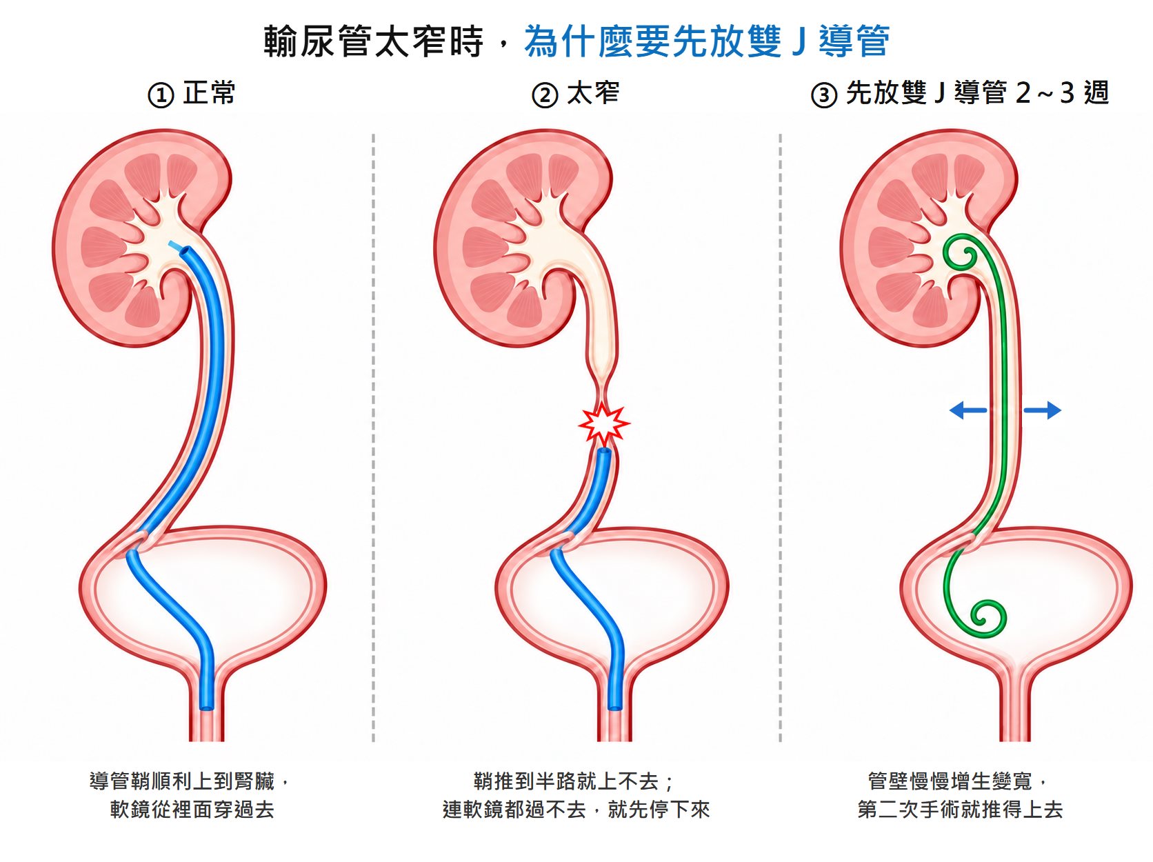 三格示意圖，標題「輸尿管太窄時，為什麼要先放雙 J 導管」。第一格「正常」：藍色的導管鞘從尿道進入膀胱、橫過膀胱進到側壁的輸尿管口，再沿著輸尿管一路上到腎臟，說明導管鞘順利上到腎臟、軟鏡從裡面穿過去。第二格「太窄」：輸尿管中段明顯變細，導管鞘推到狹窄段下方就停住，交界處畫著紅色的衝突記號，說明鞘推到半路就上不去，連軟鏡都過不去就先停下來。第三格「先放雙 J 導管 2～3 週」：一條綠色的雙 J 導管兩端分別捲在腎臟與膀胱裡，輸尿管兩側畫著向外的箭頭，說明管壁慢慢增生變寬，第二次手術就推得上去
