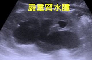 腎臟超音波影像，中央原本該是腎盂的位置出現大片黑色的積水區域，左上角標示「嚴重腎水腫」