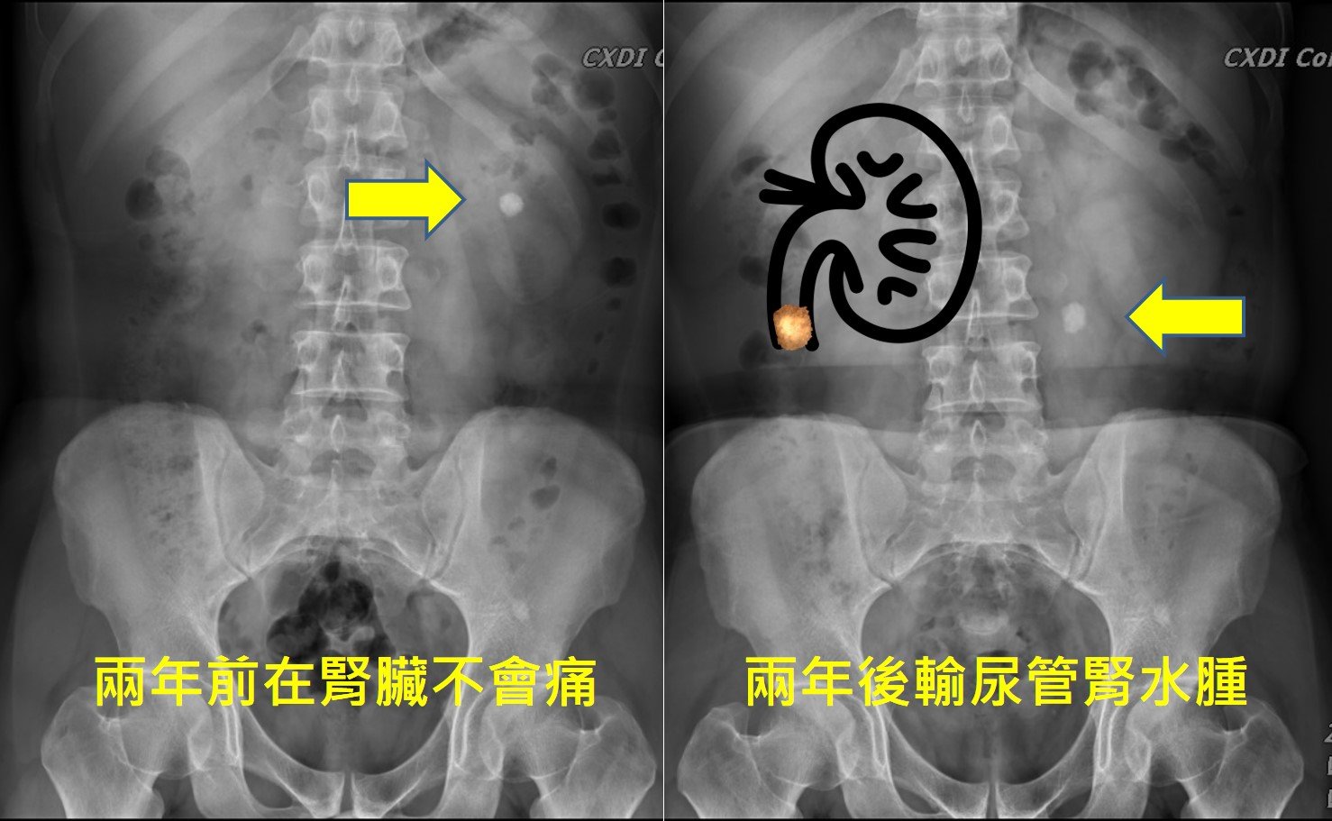 同一位病人兩張腹部 X 光併排：左圖標示「兩年前在腎臟不會痛」，箭頭指向左腎內一顆白色結石；右圖標示「兩年後輸尿管腎水腫」，圖上描出腎臟輪廓，箭頭指向已經移到輸尿管的那顆結石