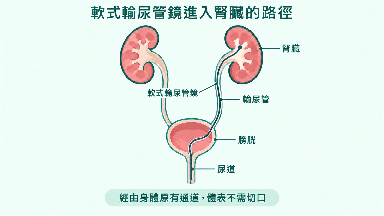 示意圖：泌尿系統剖面，一條標示為「軟式輸尿管鏡」的細管從尿道進入、穿過膀胱、沿右側輸尿管上行進入腎臟，圖上並標示尿道、膀胱、輸尿管、腎臟，註明經由身體原有通道、體表不需切口