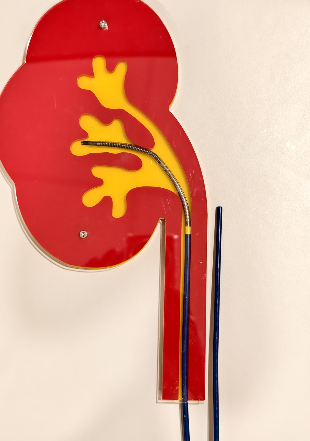 腎臟教學模型上，可彎吸石鞘從輸尿管往上延伸，在腎臟內彎折進入腎盞；旁邊另立著一根筆直的傳統導管鞘作為對照，只停在輸尿管與腎臟交接的位置