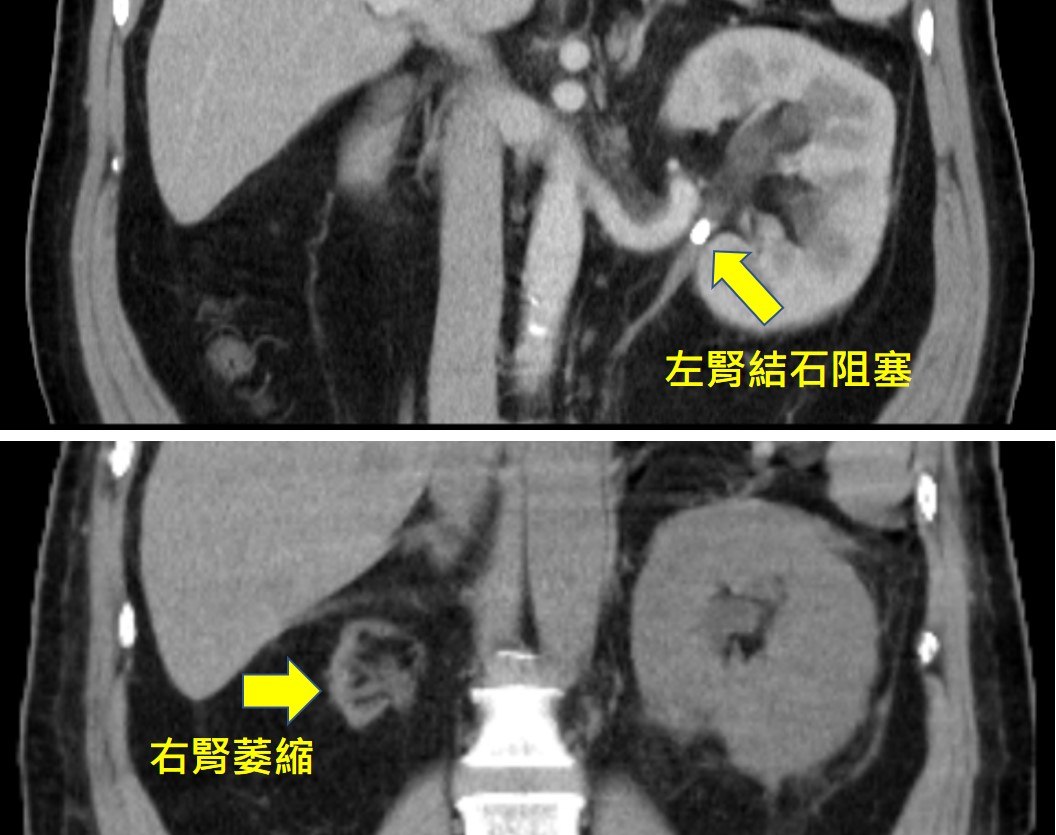 同一位病人的兩張電腦斷層冠狀切面：上圖以箭頭標示左腎出口處一顆明亮的結石，註明「左腎結石阻塞」；下圖以箭頭指向右側明顯縮小、結構模糊的腎臟，註明「右腎萎縮」