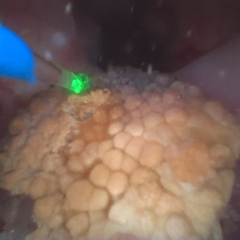 內視鏡畫面，一大塊淡橘黃色的結石，表面像一顆顆小泡泡擠在一起，左上角藍色的雷射光纖打在邊緣，發出綠色亮點
