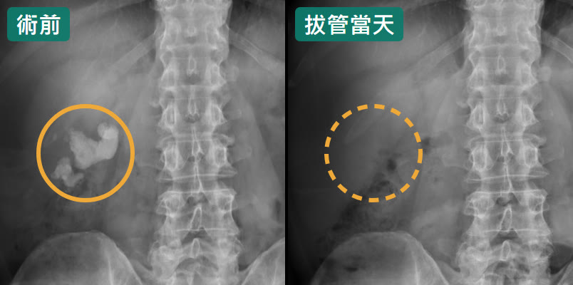 兩張腹部 X 光並排，左上角有墨綠色標籤。左邊「術前」，畫面上脊椎左邊（病人的右腎），琥珀色圈裡有一大塊不規則的白色結石；右邊「拔管當天」，同一個位置用虛線圈標出，已經看不到結石