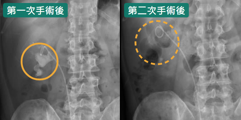 兩張腹部 X 光並排。左邊「第一次手術後」，右腎位置多了一條雙 J 導管，琥珀色圈裡還有一塊白色結石；右邊「第二次手術後」，虛線圈裡只看得到雙 J 導管上端捲起來的小圈，看不到結石