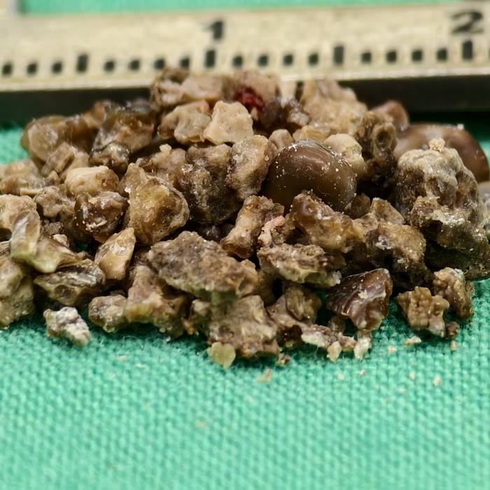 綠色手術鋪單上一堆褐色、有稜有角的碎石塊，大小幾公釐，後面一把卡尺