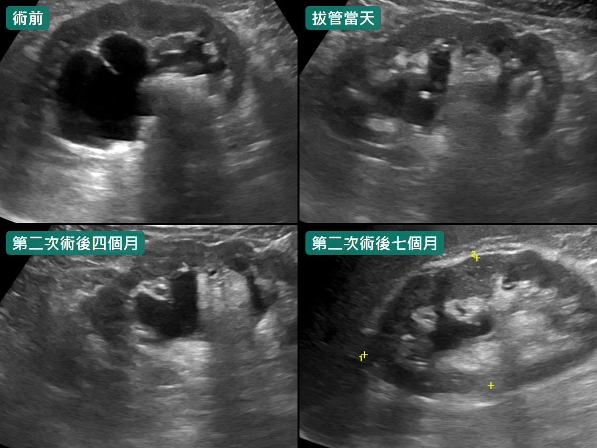 四張腎臟超音波排成兩列，每張左上角有墨綠色標籤。「術前」腎臟中間有一大片撐開的黑色積水；「拔管當天」黑色區域變小，但還看得到；「第二次術後四個月」、「第二次術後七個月」黑色區域比術前小很多，七個月時最小