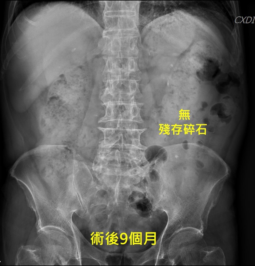 腹部 X 光，腎臟與輸尿管區域已無任何高密度結石影，畫面下方標示「術後 9 個月 無殘存碎石」