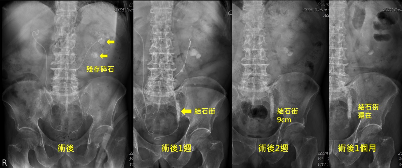 同一位病人的四張腹部 X 光併排，依序標示術後、術後一週、術後兩週、術後一個月；第三張以箭頭標出下段輸尿管內一長串約九公分的碎石，第四張顯示它仍然停在原處