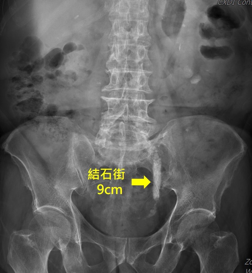 腹部 X 光特寫，下段輸尿管內可見一長串連續的高密度碎石影，以黃色箭頭與文字標示「結石街 9cm」