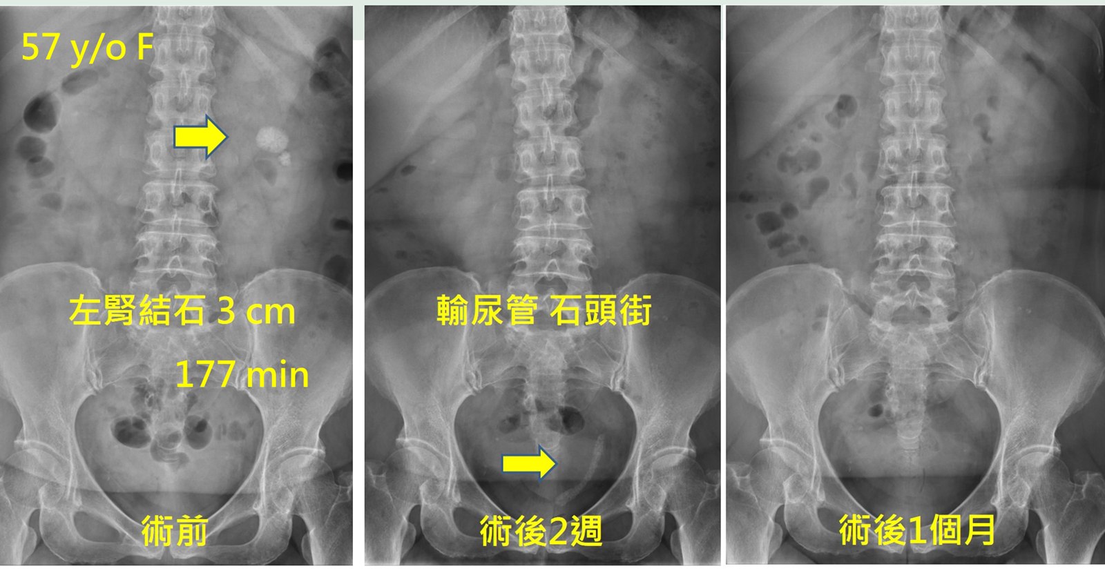 同一位病人的三張腹部 X 光併排：左側術前以箭頭指出左腎一顆三公分的結石；中間術後兩週在下段輸尿管出現一串堆疊的碎石影像，標註為輸尿管石頭街；右側術後一個月已完全看不到結石