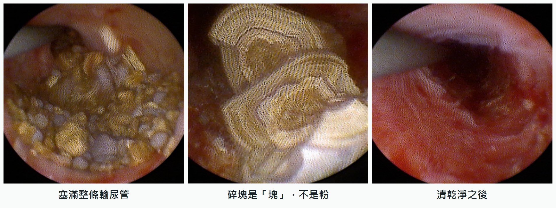 第二次手術的三張內視鏡畫面併排：左圖輸尿管管腔被大小不一的黃褐色碎石完全填滿；中圖一塊碎石的斷面呈現清楚的同心層狀紋路；右圖碎石清除後，管腔恢復通暢，只見粉紅色的黏膜