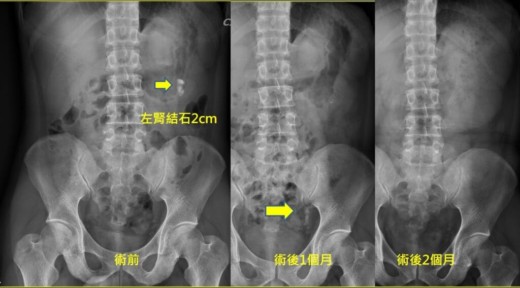 同一位病人的三張腹部 X 光併排：術前以箭頭指出左腎一顆兩公分的結石；術後一個月在左側下段輸尿管出現一小串碎石影；術後兩個月該處已經乾淨