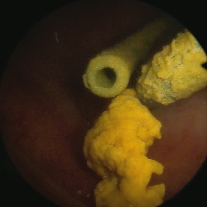 圓形的膀胱鏡畫面:一段雙 J 導管的末端,黏著一大塊黃色、表面凹凸不平的結石,另一段管子外面也是黃色的結晶