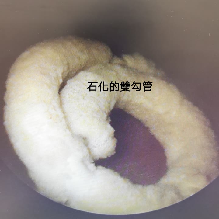 圓形的膀胱鏡畫面:雙 J 導管在膀胱裡捲成一圈,整圈外面包了一層厚厚的白色、蓬鬆粗糙的結石,已經看不到原本的管子,畫面上有「石化的雙勾管」字樣