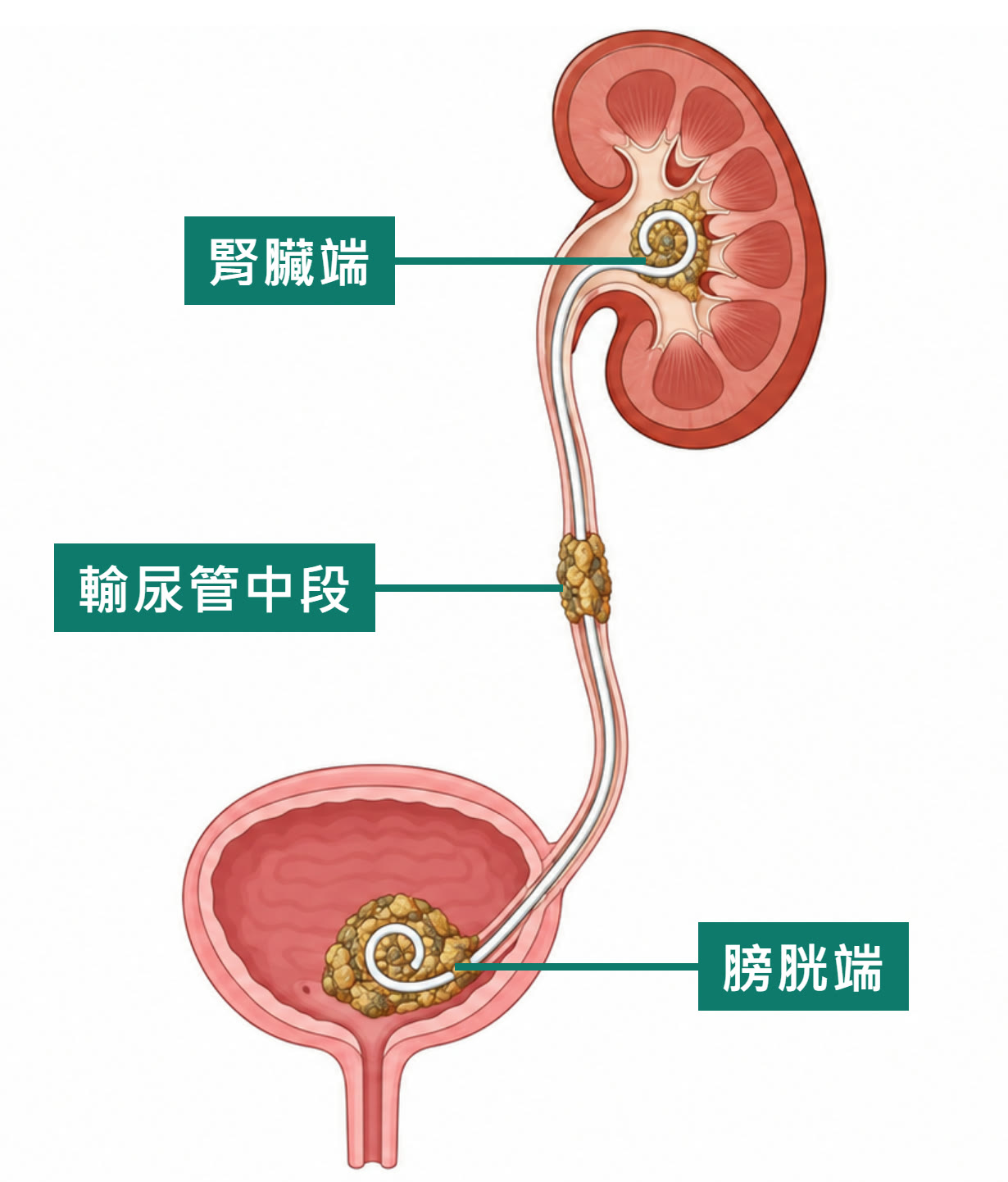 泌尿系統示意圖：一根白色雙 J 導管從腎臟沿著輸尿管通到膀胱，上端在腎盂裡捲成圈、下端在膀胱裡捲成圈。管子在三個地方包著黃褐色的結石，分別標示「腎臟端」「輸尿管中段」「膀胱端」，膀胱端的結石最大