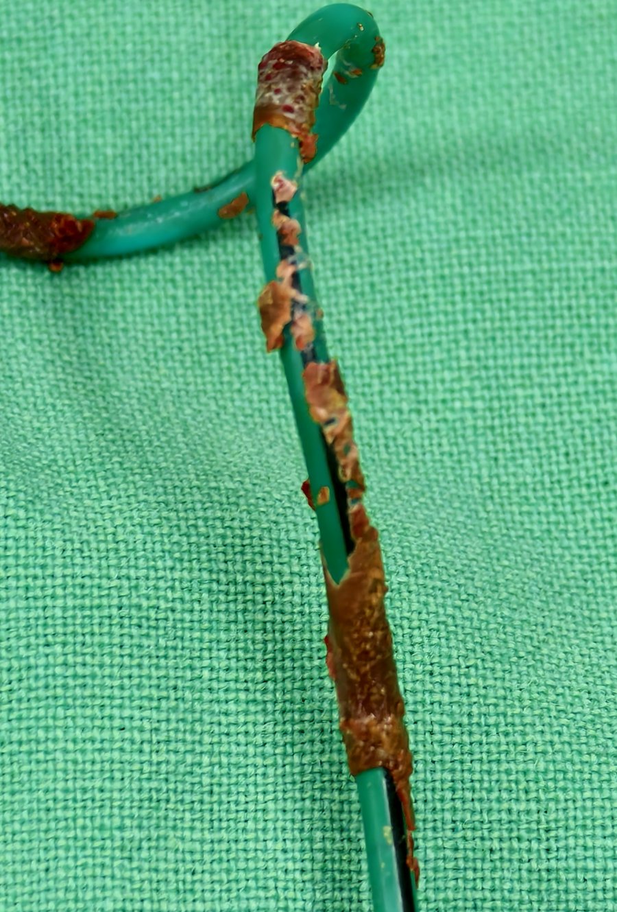 手術取出的雙 J 導管，原本光滑的綠色管身上附著大量黃褐色結石沉積物，一塊一塊包覆在管壁與捲曲端上