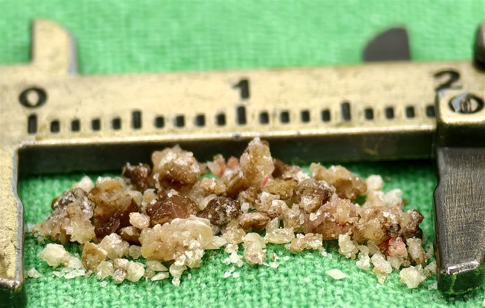 綠色手術鋪單上，一小堆淺褐與米白色的腎結石碎塊攤在游標卡尺的量爪之間，整堆橫跨約兩公分，單一碎塊都只有幾毫米大