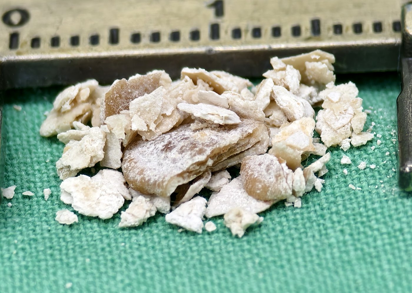 卡尺旁一堆灰白到米白色、一片一片薄層狀的結石碎片