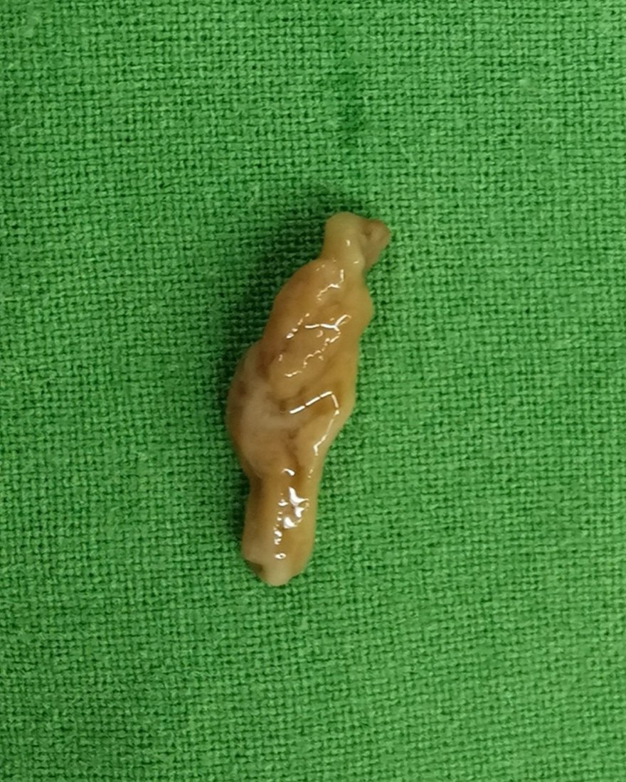 綠色手術鋪單上一顆完整取出的感染性結石,長條狀、蠟黃色,表面濕潤光滑,看起來柔軟有黏性