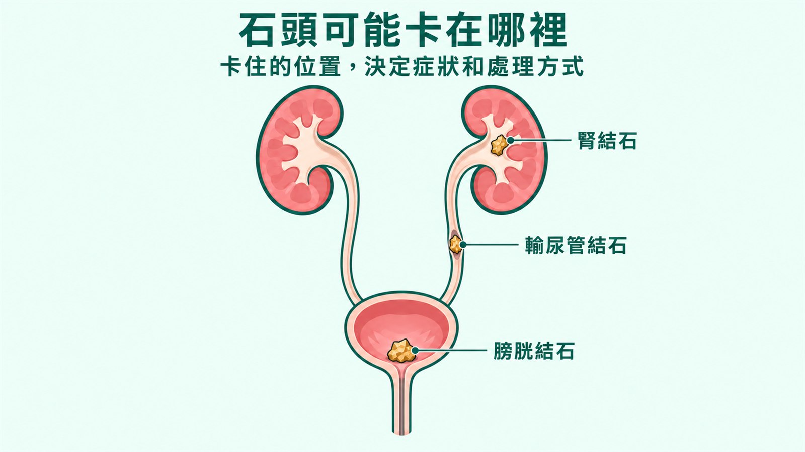 泌尿系統剖面示意圖，兩側腎臟經輸尿管連到膀胱與尿道，三顆土黃色的不規則結石分別卡在腎盞、輸尿管中段與膀胱底部