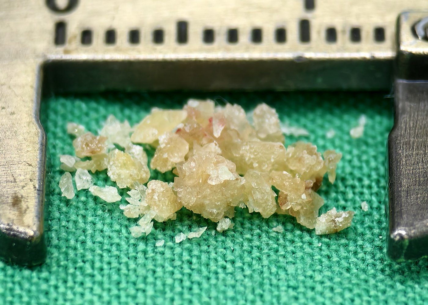 游標卡尺旁的一堆結石碎粒,顏色偏淡黃與米白、略帶半透明,表面布滿細小的結晶顆粒,整堆寬度約一公分