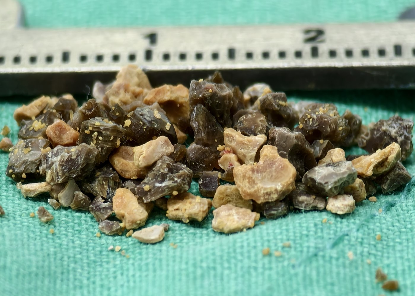 游標卡尺旁的一大堆結石碎粒,顏色從米白、土黃、灰褐到接近黑色都有,形狀大小也不一致