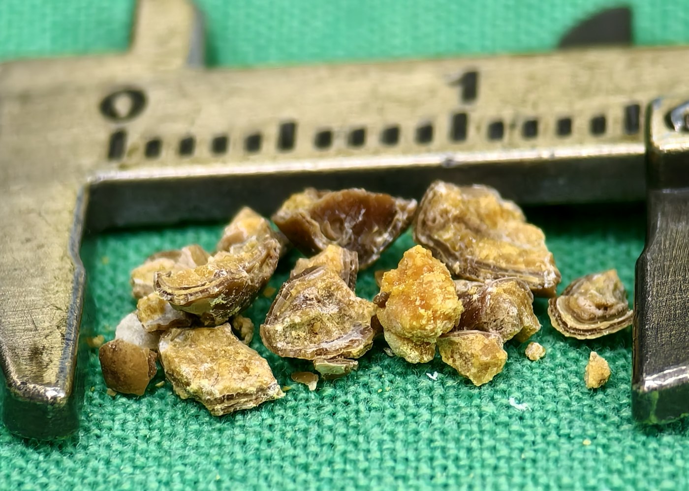 游標卡尺旁的一排結石碎粒,呈金黃色與土黃色,表面帶有層層堆疊的紋理,整排寬度約一公分